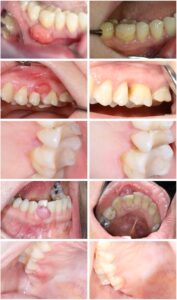 口腔粘膜の変化の画像ギャラリー_図24