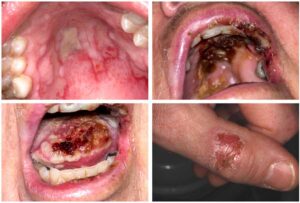 口腔粘膜の変化の画像ギャラリー_図25