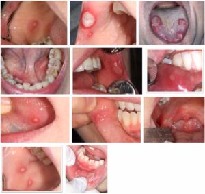 口腔粘膜の変化の画像ギャラリー_図3