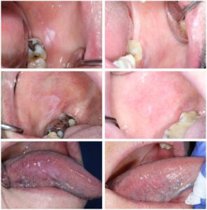 口腔粘膜の変化の画像ギャラリー_図8