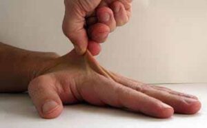 エーラス・ダンロス症候群と顎機能障害_図2