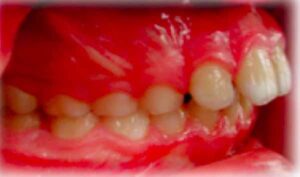 子供の大きな出っ歯_図2