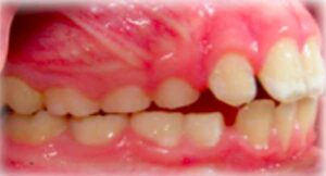 子供の大きな出っ歯_図3