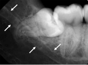 第三大臼歯に対する下顎管の位置_図1
