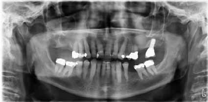 歯科副鼻腔炎_図1