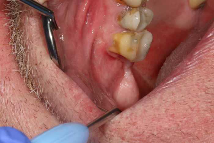 歯科副鼻腔炎_図4e