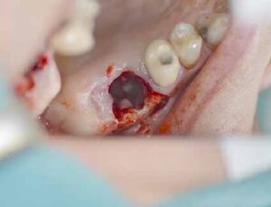 歯科副鼻腔炎_図2b