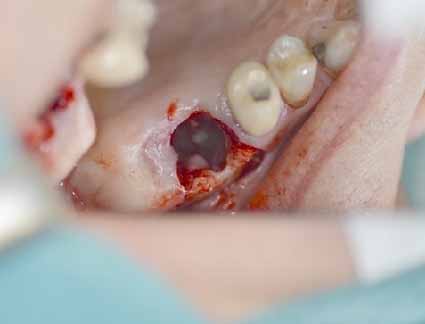 歯科副鼻腔炎_図2b