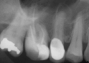 歯科副鼻腔炎_図3a