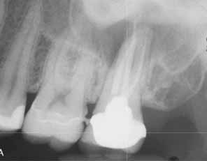 歯科副鼻腔炎_図3b