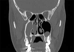 歯科副鼻腔炎_図3c