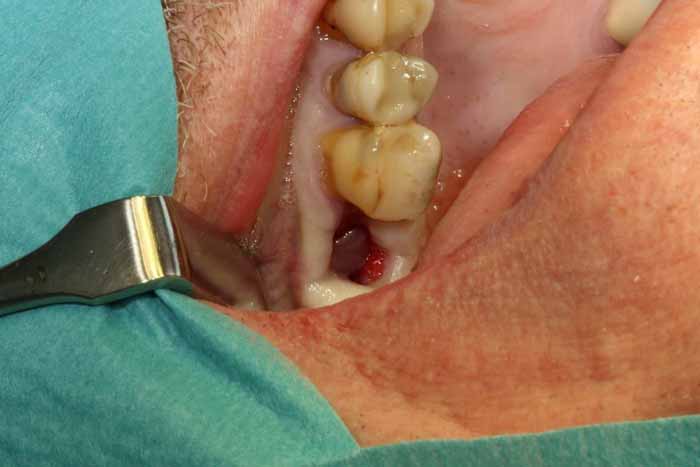 歯科副鼻腔炎_図4a