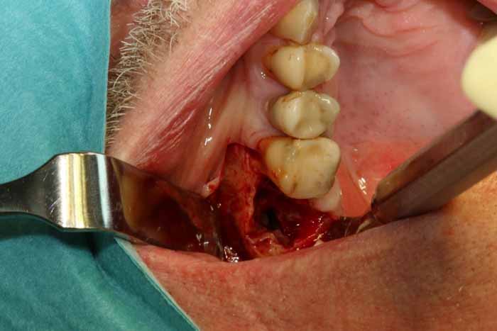 歯科副鼻腔炎_図4b
