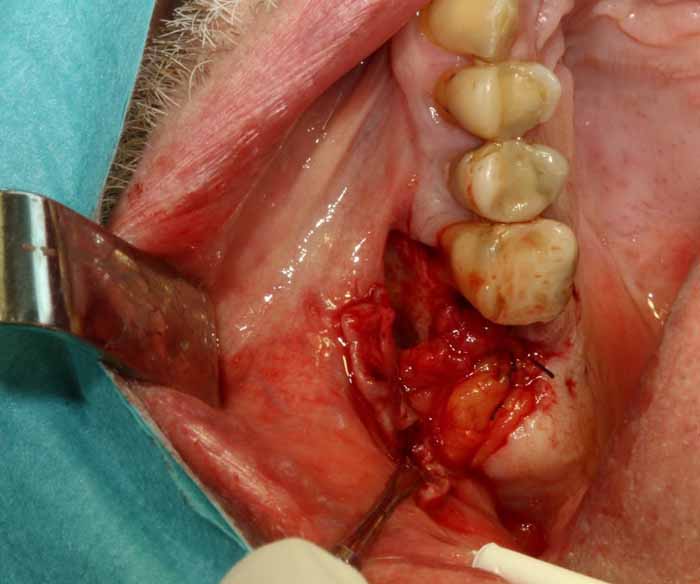 歯科副鼻腔炎_図4c