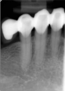 自由端の歯の欠損、片側および両側_図4