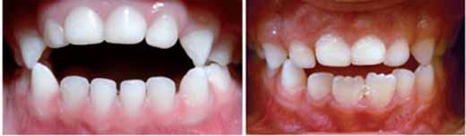 3歳から7歳までの咬合異常の変化_図1