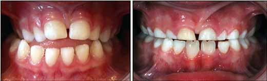 3歳から7歳までの咬合異常の変化_図3