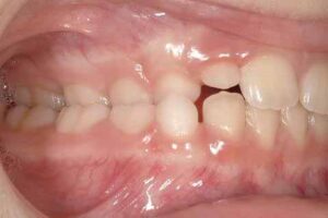 交叉咬合、片側_図1