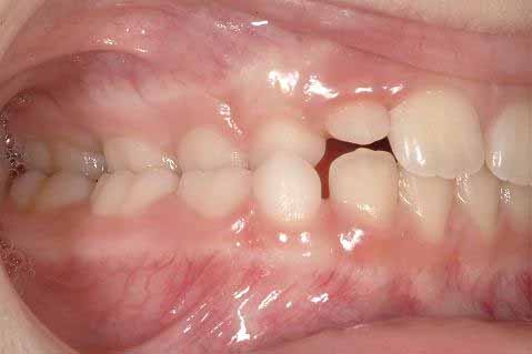 交叉咬合、片側_図1