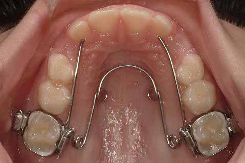 交叉咬合、片側_図2