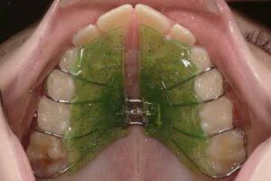 交叉咬合、片側_図3