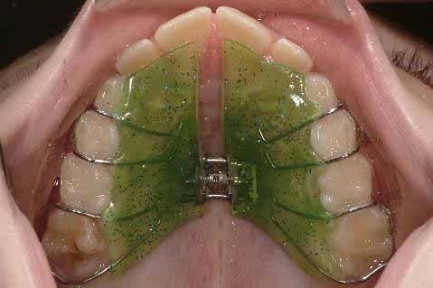 交叉咬合、片側_図3