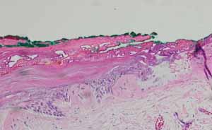 口腔内の生検_図4