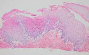 口腔内の生検_図6