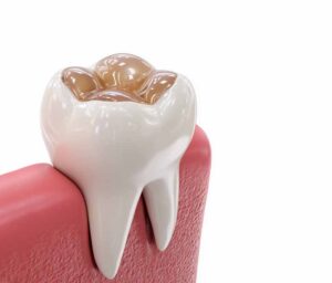 オールセラミックのオンレー