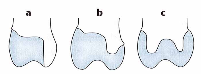 オールセラミックのオンレー_図1
