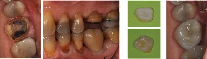 オールセラミックのオンレー_図2