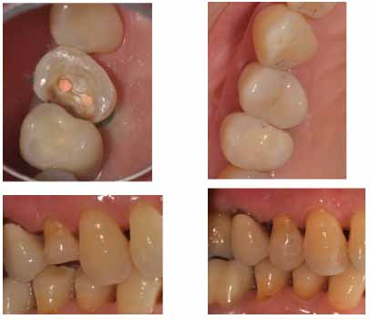 オールセラミックのオンレー_図4