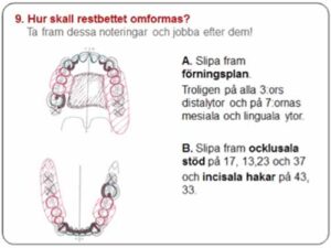 部分入れ歯 - 設計原則_図6e