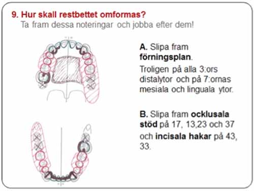 部分入れ歯 - 設計原則_図6e