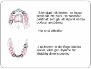 部分入れ歯 - 設計原則_図7a