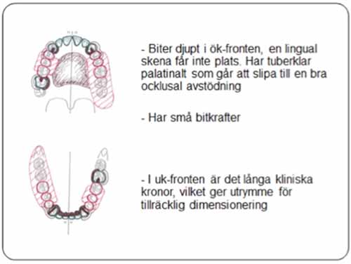 部分入れ歯 - 設計原則_図7a