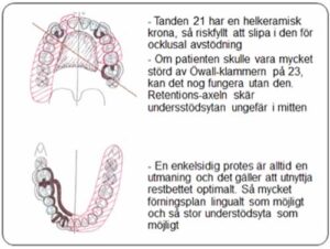 部分入れ歯 - 設計原則_図7b