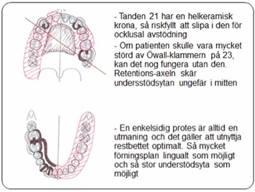 部分入れ歯 - 設計原則_図7b