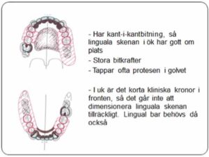 部分入れ歯 - 設計原則_図7c