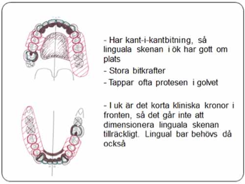 部分入れ歯 - 設計原則_図7c