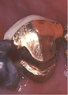 部分入れ歯 - 設計原則_図3