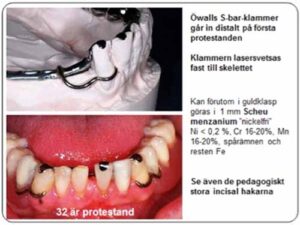 部分入れ歯 - 設計原則_図4