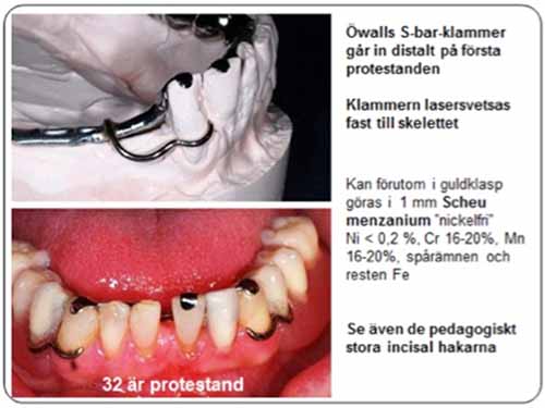 部分入れ歯 - 設計原則_図4
