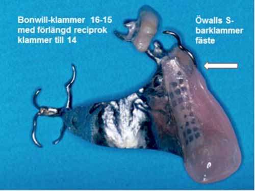 部分入れ歯 - 設計原則_図5