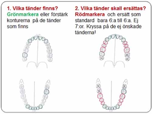 部分入れ歯 - 設計原則_図6a