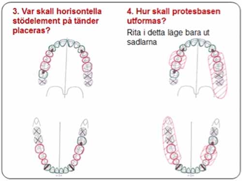 部分入れ歯 - 設計原則_図6b