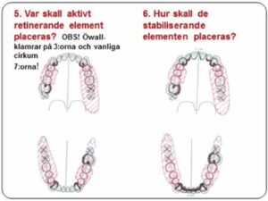 部分入れ歯 - 設計原則_図6c