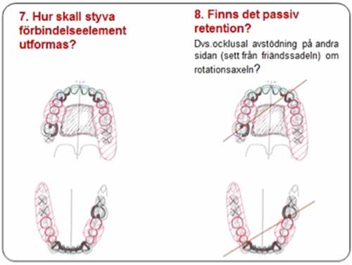 部分入れ歯 - 設計原則_図6d