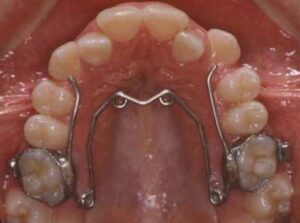 四重らせん（QH）_図5