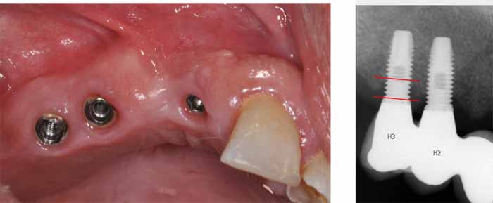 SKRI - スウェーデン歯科インプラント品質登録_図1